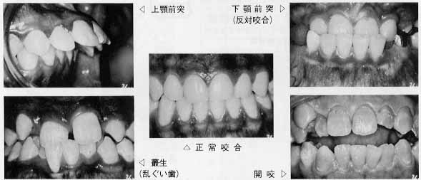 咬合異常（かみ合わせがよくない）
	