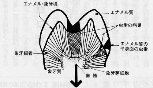 歯髄炎