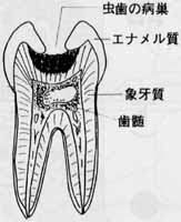 歯髄炎