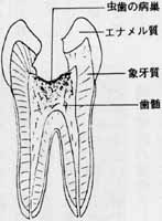 歯髄炎