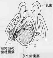 歯髄炎